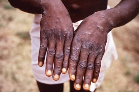A file photo of someone with Monkeypox