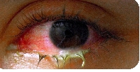 The Kampala Capital City Authority  says conjunctivitis cases have also been reported in schools