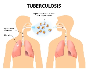 Tuberculosis Dreamstime
