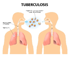 TB infection is spread through droplets from an infected person