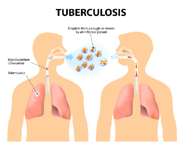 TB infection is spread through droplets from an infected person