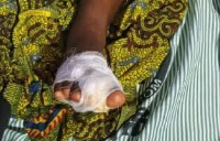 The suspect is reported to have used a pair of scissors to cut off the girl’s right second toe