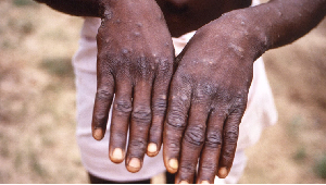 Symptoms of mpox include fever, aches and skin lesions