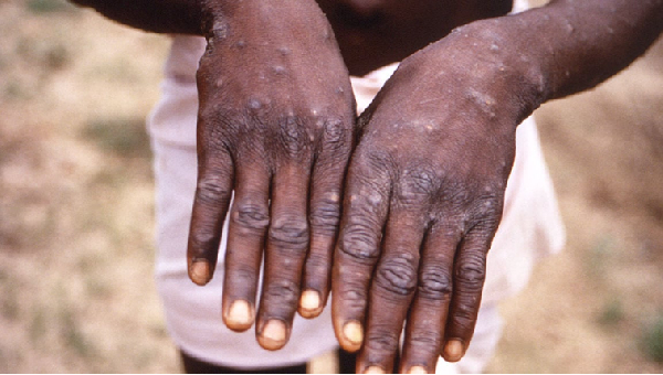 Symptoms of mpox include fever, aches and skin lesions