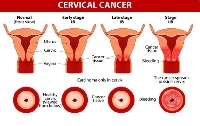 The Epidemiologist said cervical cancer is preventable and curable.