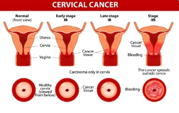 The Epidemiologist said cervical cancer is preventable and curable.