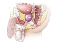 An illustration of Prostate cancer in men