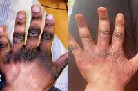 A file photo depicting an aftermath of skin bleaching