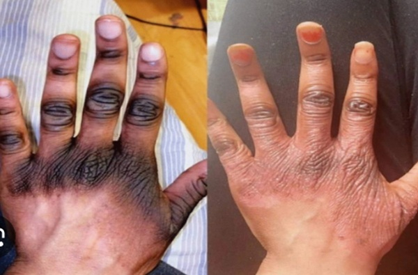 A file photo depicting an aftermath of skin bleaching