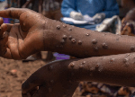 Ghana’s Mpox cases reach 980 after 12 new infections