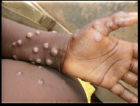 File photo: A Monkeypox victim