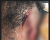 Yaa Achiaa is currently receiving treatment at the Barekese Hospital