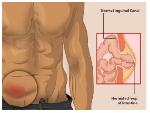 EXPLAINER: What is hernia, and why does it happen?