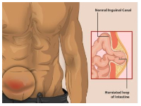 Hernia most commonly affects the abdomen and groin area