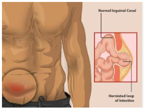 Hernia most commonly affects the abdomen and groin area