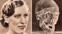 An X-ray of Isabella Ruxton's skull was a crucial piece of evidence in the case