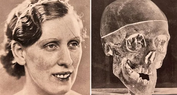 An X-ray of Isabella Ruxton's skull was a crucial piece of evidence in the case