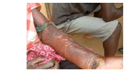 One of the affected residents shows some wounds he sustained as a result of the yet be identified di