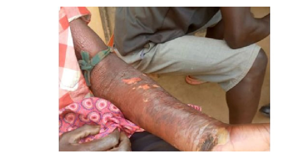 One of the affected residents shows some wounds he sustained as a result of the yet be identified di