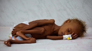 Malnutrition Yemen Hunger