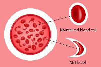 An image showing the shape of a normal red blood cell and a sickle cell