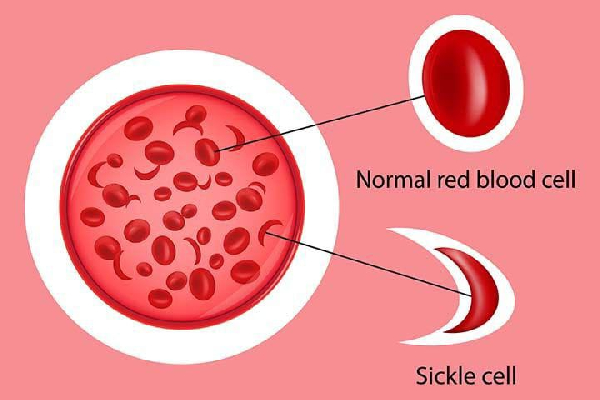 An image showing the shape of a normal red blood cell and a sickle cell