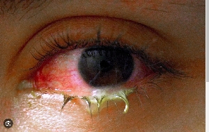 Conjunctivitis .png