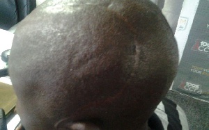 The victim Danso has several scars on his head