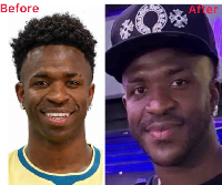 Vinicius Jr's facial appearance before and after the surgery