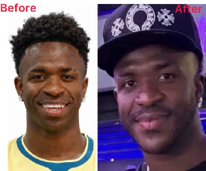 Vinicius Jr's facial appearance before and after the surgery Vinicius Jr's facial appearance before and after the surgery