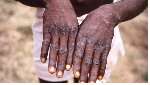 Congo Brazzaville declares mpox epidemic
