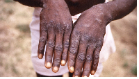 Symptoms of mpox include fever, aches and skin lesions.