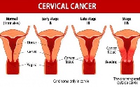 The risk of developing cervical cancer is present in both younger and middle aged women