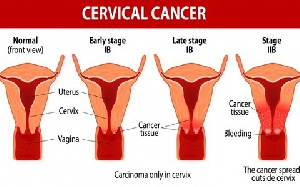 Cervix Cancer Two