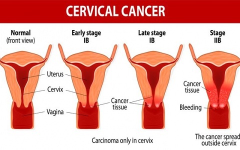 The risk of developing cervical cancer is present in both younger and middle aged women