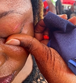 Dzifa Doris Kaledzi, who was attacked by the DCE, sustained a cut above her eyelid