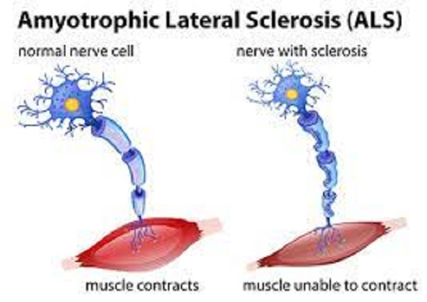 Amyotrophic Lateral Sclerosis (ALS)