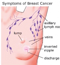 The Koforidua Regional Hospital recorded an average of six to nine breast cancer cases per week