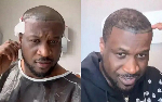 Peter Okoye undergoes hair implant