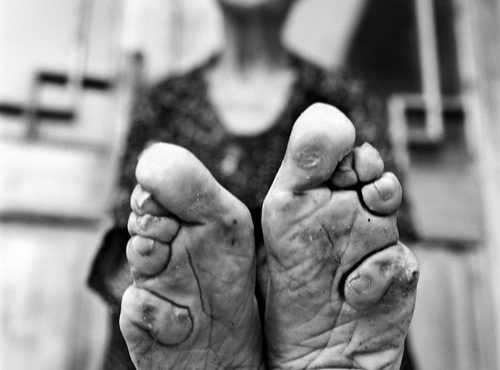 Bound feet of China woman