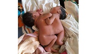 The conjoined twin girls at Busolwe Hospital in Butaleja District
