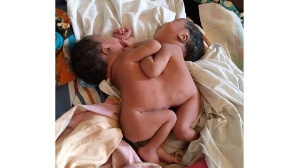 The conjoined twin girls at Busolwe Hospital in Butaleja District