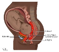 Obstetric Fistula (OBF) is an abnormal connection between the rectum and the vagina