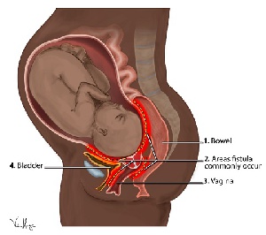 Obstetric fistula is an abnormal hole between the birth canal and the bladder