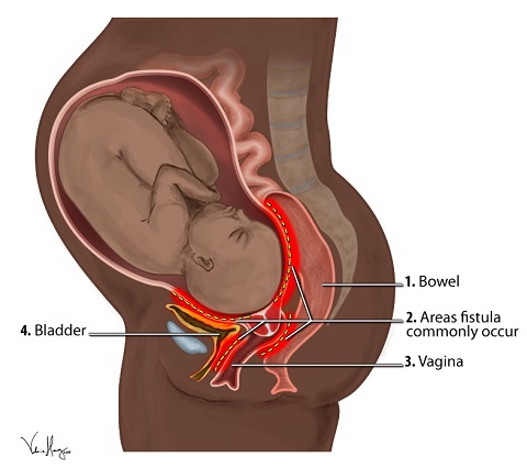 Obstetric fistula is an abnormal hole between the birth canal and the bladder