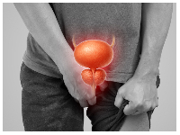 File photo a man suffering from prostrate cancer