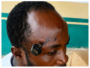 Stabbed In Skull