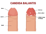 What men need to know about Candida Balanitis