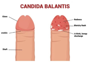 File photo of Candida Balanitis