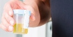 Urine test can spot more than nine in 10 bladder cancers
